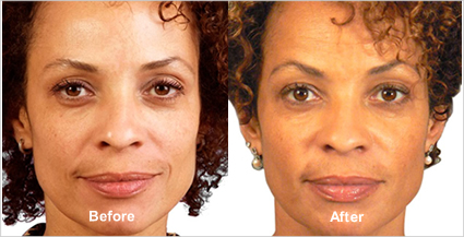 JUVÉDERM® Before & After Photo, Tampa Ear, Nose And Throat Associates
