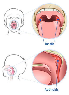 Tonsils & Adenoids, Tampa Florida ENT