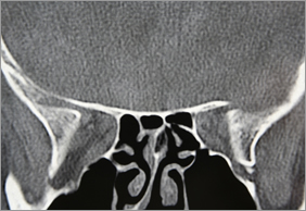 Sinus Cavity, Tampa Florida ENT